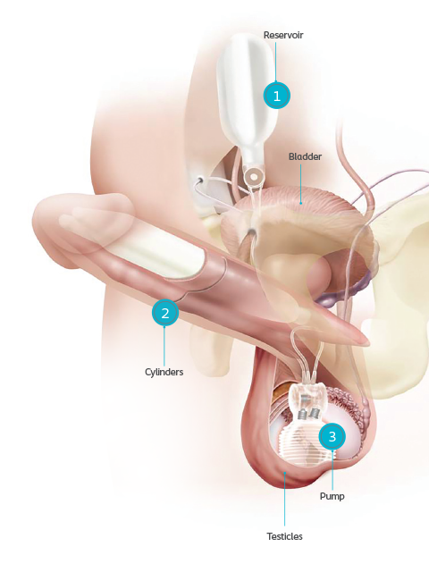 Penile-Implant-Page_Titan